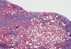 HCV in Older Adults: Effects of Prolonged Infection, Aging-Related Mechanisms, and Treatment HCV in Older Adults: Effects of Prolonged Infection, Aging-Related Mechanisms, and Treatment