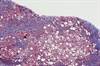 Interferon Alfa May Decrease the Incidence of Chronic HCV Infection Interferon Alfa May Decrease the Incidence of Chronic HCV Infection