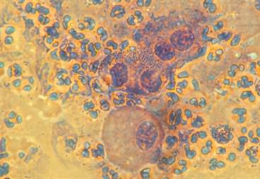 Antibiotic-Resistant Gonorrhea: Prevention Strategies for a Growing Threat Antibiotic-Resistant Gonorrhea: Prevention Strategies for a Growing Threat