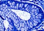 Novel <i>H pylori</i> Eradication Therapy Effective in Phase 3 Trial Novel <i>H pylori</i> Eradication Therapy Effective in Phase 3 Trial