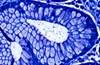 Novel <i>H pylori</i> Eradication Therapy Effective in Phase 3 Trial Novel <i>H pylori</i> Eradication Therapy Effective in Phase 3 Trial