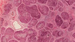 SVR was independently associated with protection from liver fibrosis progression after adjustments for baseline ALT, duration of HCV infection, and mode of acquisition. SVR was independently associated with protection from liver fibrosis progression after adjustments for baseline ALT, duration of HCV infection, and mode of acquisition.
