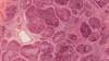 Curative HCV Treatment Halts Liver Fibrosis Progression Curative HCV Treatment Halts Liver Fibrosis Progression