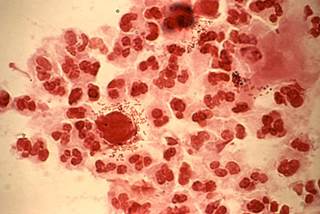 US states with the highest rates of <i>T vaginalis</i> positivity were Mississippi, Wisconsin, and South Carolina. <i>Photo Credit: CDC.</i> US states with the highest rates of <i>T vaginalis</i> positivity were Mississippi, Wisconsin, and South Carolina. <i>Photo Credit: CDC.</i>