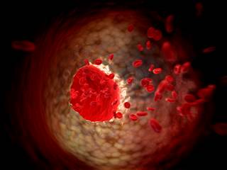 If the association between chronic CHC and CVD were more conclusive, an argument could be made to initiate HCV treatment based on considerations beyond staging of liver disease alone. If the association between chronic CHC and CVD were more conclusive, an argument could be made to initiate HCV treatment based on considerations beyond staging of liver disease alone.