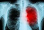 Case Study: Persistent Upper Respiratory Infection in a 44-Year-Old Man Case Study: Persistent Upper Respiratory Infection in a 44-Year-Old Man