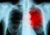 Case Study: Persistent Upper Respiratory Infection in a 44-Year-Old Man Case Study: Persistent Upper Respiratory Infection in a 44-Year-Old Man