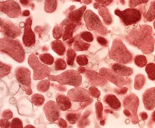 <i>M genitalium</i> prevalence was higher among women aged 15 to 21 years than those aged 22 to 25 years. <i>Photo Credit: SPL/Science Source.</i> <i>M genitalium</i> prevalence was higher among women aged 15 to 21 years than those aged 22 to 25 years. <i>Photo Credit: SPL/Science Source.</i>