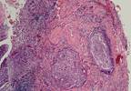 HPV Screening Associated With Reduced Remaining Lifetime Cervical Cancer Risk in Older Women HPV Screening Associated With Reduced Remaining Lifetime Cervical Cancer Risk in Older Women