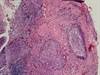 Improving Outcomes in HPV- and HIV-Related Cervical Cancer Improving Outcomes in HPV- and HIV-Related Cervical Cancer
