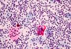 Parental Consent as a Barrier to HPV Vaccination: Should Adolescents Call the Shots? Parental Consent as a Barrier to HPV Vaccination: Should Adolescents Call the Shots?