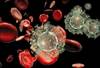 Greater Temporal Summation of Pain in HIV With Chronic Pain Greater Temporal Summation of Pain in HIV With Chronic Pain