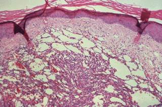 The majority of participants were men (71%) and African (93%), median age was 34 years with a median CD4 count of 184 cells/mm<sup>3</sup>. <i>Photo Credit: CDC/ Dr Peter Drotman.</i> The majority of participants were men (71%) and African (93%), median age was 34 years with a median CD4 count of 184 cells/mm<sup>3</sup>. <i>Photo Credit: CDC/ Dr Peter Drotman.</i>