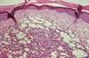 Efficacy of Immediate Oral Etoposide for Mild to Moderate AIDS-Related Kaposi Sarcoma Efficacy of Immediate Oral Etoposide for Mild to Moderate AIDS-Related Kaposi Sarcoma