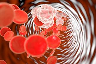 Inflammation is thought to play a role in comorbidities such as cardiovascular disease, neurocognitive impairment, and non-AIDS-related cancers. Inflammation is thought to play a role in comorbidities such as cardiovascular disease, neurocognitive impairment, and non-AIDS-related cancers.