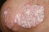 Skin Manifestations of Chronic Hepatitis C Virus Infection Skin Manifestations of Chronic Hepatitis C Virus Infection