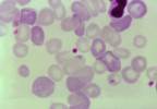 FDA Approves Blood Screens for Tickborne Parasite FDA Approves Blood Screens for Tickborne Parasite