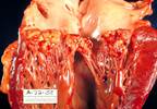 Severe Liver Failure Is Strongest Independent Risk Factor for Mortality in Infectious Endocarditis Severe Liver Failure Is Strongest Independent Risk Factor for Mortality in Infectious Endocarditis