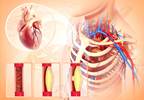 Hepatitis C Eradication With DAAs Improves Carotid Atherosclerosis Hepatitis C Eradication With DAAs Improves Carotid Atherosclerosis