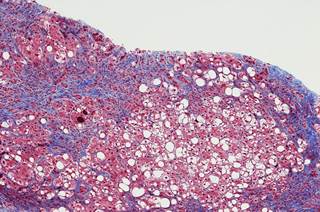 Sex, pretreatment fibrosis stage, age at SVR, alcohol consumption, body mass index, and diabetes at follow-up were analyzed for association with persistent fibrosis. Sex, pretreatment fibrosis stage, age at SVR, alcohol consumption, body mass index, and diabetes at follow-up were analyzed for association with persistent fibrosis.