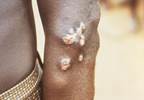 Standard-Dose vs Low-Dose Azithromycin for Treatment of Yaws Standard-Dose vs Low-Dose Azithromycin for Treatment of Yaws