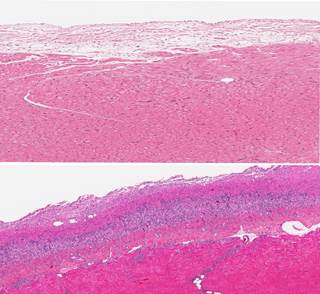 There was no increased risk of myopericarditis in the 42 days following vaccination. There was no increased risk of myopericarditis in the 42 days following vaccination.