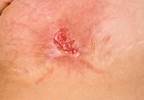 Adjunctive Antibiotic Therapy Yields Modest Benefit in Uncomplicated Skin Abscesses Adjunctive Antibiotic Therapy Yields Modest Benefit in Uncomplicated Skin Abscesses