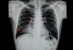 Bacterial Pneumonia-Complicating Influenza: Risks, Morbidity, and Mortality Bacterial Pneumonia-Complicating Influenza: Risks, Morbidity, and Mortality