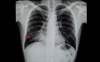 Bacterial Pneumonia-Complicating Influenza: Risks, Morbidity, and Mortality Bacterial Pneumonia-Complicating Influenza: Risks, Morbidity, and Mortality