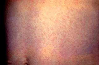 There has been an increase in measles cases across the United States and worldwide. There has been an increase in measles cases across the United States and worldwide.