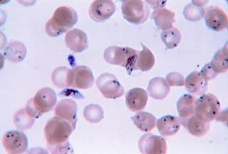 WHO recommends that women who have uncomplicated malaria infected with <i>P falciparum</i> during the first trimester take quinine with clindamycin for 7 days. <i>Photo credit: CDC.</i> WHO recommends that women who have uncomplicated malaria infected with <i>P falciparum</i> during the first trimester take quinine with clindamycin for 7 days. <i>Photo credit: CDC.</i>