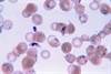 Malaria Therapy During Pregnancy Needs a Translational Booster Malaria Therapy During Pregnancy Needs a Translational Booster