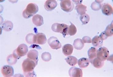 Malaria Therapy During Pregnancy Needs a Translational Booster Malaria Therapy During Pregnancy Needs a Translational Booster