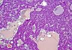 BMI Linked to Hepatocellular Carcinoma Risk in Chronic Hepatitis B Virus BMI Linked to Hepatocellular Carcinoma Risk in Chronic Hepatitis B Virus