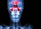 Duration of Antibiotics Often Exceeds Guidelines for Sinusitis Duration of Antibiotics Often Exceeds Guidelines for Sinusitis