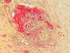 When to Suspect GBS Cellulitis and Necrotizing Fasciitis in Infants When to Suspect GBS Cellulitis and Necrotizing Fasciitis in Infants