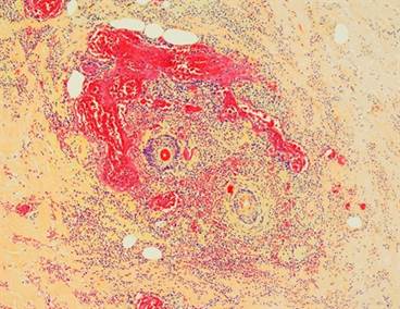 When to Suspect GBS Cellulitis and Necrotizing Fasciitis in Infants When to Suspect GBS Cellulitis and Necrotizing Fasciitis in Infants