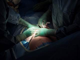 Repeat cesarean deliveries increased from 16% of all cesarean deliveries in 1998 to 42% in 2013. Repeat cesarean deliveries increased from 16% of all cesarean deliveries in 1998 to 42% in 2013.