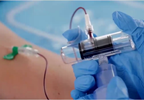 Curbing Overuse of Blood Cultures in the Emergency Department Curbing Overuse of Blood Cultures in the Emergency Department