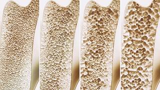 Denosumab inhibits osteoclast formation and activity in cortical bone, and this mechanism of action may be reflected by the reduction of erosion in both depth and surface. Denosumab inhibits osteoclast formation and activity in cortical bone, and this mechanism of action may be reflected by the reduction of erosion in both depth and surface.