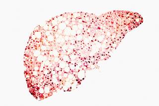 In patients with HBV/HCV coinfection, triglycerides were higher but total cholesterol was lower compared with individuals with HCV. In patients with HBV/HCV coinfection, triglycerides were higher but total cholesterol was lower compared with individuals with HCV.
