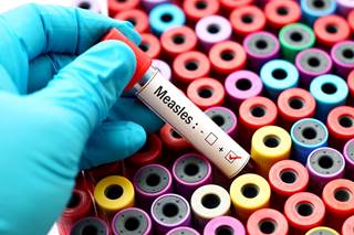 A lack of protection against measles was detected in one-fifth of the subjects who underwent testing for the infection. A lack of protection against measles was detected in one-fifth of the subjects who underwent testing for the infection.