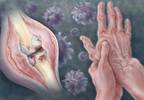 Patients With Rheumatic Diseases Need to Be Monitored for HBV Reactivation Patients With Rheumatic Diseases Need to Be Monitored for HBV Reactivation