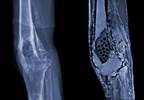 Military Personnel Remain at Risk for Infection Long After Hospital Discharge Military Personnel Remain at Risk for Infection Long After Hospital Discharge