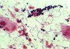 First-in-Class Antifungal Fast-Tracked for Vulvovaginal Candidiasis First-in-Class Antifungal Fast-Tracked for Vulvovaginal Candidiasis