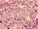 Legionella Pneumonia Outcomes Similar in Adults With/Without HIV Legionella Pneumonia Outcomes Similar in Adults With/Without HIV