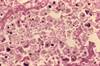 <i>Legionella</i> Pneumonia Outcomes Similar in Adults With/Without HIV <i>Legionella</i> Pneumonia Outcomes Similar in Adults With/Without HIV