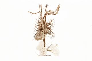 Mineralocorticoid receptor antagonism with eplerenone was well-tolerated in the HIV population with no significant changes in blood pressure or potassium. Mineralocorticoid receptor antagonism with eplerenone was well-tolerated in the HIV population with no significant changes in blood pressure or potassium.