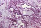 Risk for Breakthrough Invasive Fungal Infections With Isavuconazole: More Data Needed Risk for Breakthrough Invasive Fungal Infections With Isavuconazole: More Data Needed