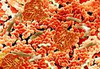 Fecal Microbiota Transplantation and Vancomycin for Recurrent C difficile Fecal Microbiota Transplantation and Vancomycin for Recurrent C difficile